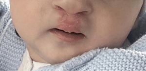 Despicături labio-maxilo-palatine la copil – rezultat după operație