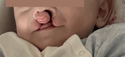 Despicături labio-maxilo-palatine la copil – aspect înainte de operație