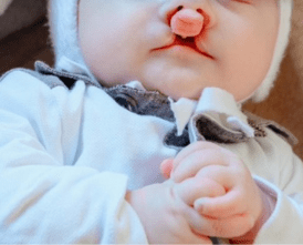 Despicături labio-maxilo-palatine – caz preoperator, GABI DANMED Chișinău